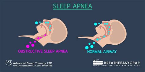 sleep apnea definition psychology quizlet